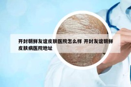 開封朝鮮友誼皮膚醫(yī)院怎么樣 開封友誼朝鮮皮膚病醫(yī)院地址