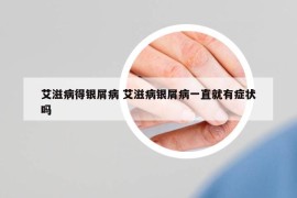 艾滋病得銀屑病 艾滋病銀屑病一直就有癥狀嗎