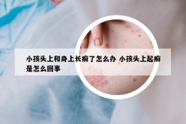 小孩頭上和身上長癬了怎么辦 小孩頭上起癬是怎么回事
