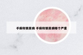 手癬和銀屑病 手癬和銀屑病哪個(gè)嚴(yán)重