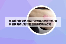銀屑病初期癥狀比較輕還需要藥物治療嗎 銀屑病初期癥狀比較輕還需要藥物治療嗎