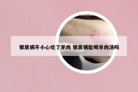 銀屑病不小心吃了羊肉 銀屑病能喝羊肉湯嗎