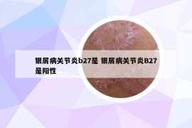 銀屑病關(guān)節(jié)炎b27是 銀屑病關(guān)節(jié)炎B27是陽(yáng)性