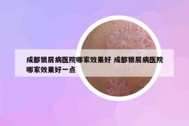 成都銀屑病醫(yī)院哪家效果好 成都銀屑病醫(yī)院哪家效果好一點