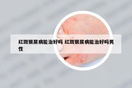 紅斑銀屑病能治好嗎 紅斑銀屑病能治好嗎男性