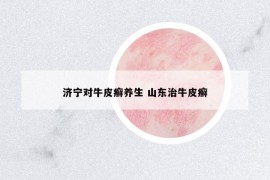濟(jì)寧對(duì)牛皮癬養(yǎng)生 山東治牛皮癬
