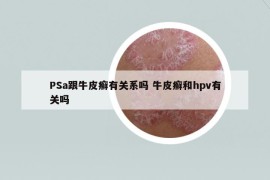 PSa跟牛皮癬有關(guān)系嗎 牛皮癬和hpv有關(guān)嗎