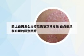 臉上白斑怎么治療能恢復(fù)正常皮膚 白點癲風(fēng)和白斑的區(qū)別圖片