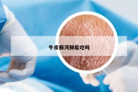 牛皮癬河鮮能吃嗎