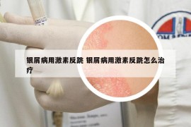 銀屑病用激素反跳 銀屑病用激素反跳怎么治療