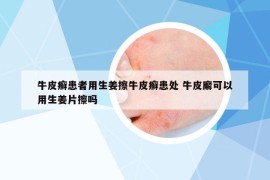牛皮癬患者用生姜擦牛皮癬患處 牛皮廨可以用生姜片擦嗎