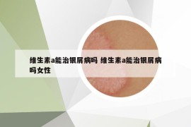 維生素a能治銀屑病嗎 維生素a能治銀屑病嗎女性