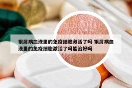 銀屑病血液里的免疫細胞激活了嗎 銀屑病血液里的免疫細胞激活了嗎能治好嗎