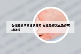 女性股癬早期癥狀圖片 女性股癬怎么治療可以除根