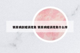銀屑病刮蠟滴現(xiàn)象 銀屑病蠟滴現(xiàn)象什么樣