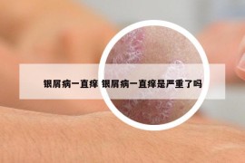 銀屑病一直癢 銀屑病一直癢是嚴重了嗎