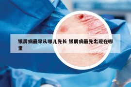銀屑病最早從哪兒先長(zhǎng) 銀屑病最先出現(xiàn)在哪里