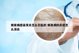 銀屑病感染發(fā)炎怎么引起的 銀屑病的炎癥怎么消去