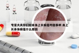 專家大夫你們好身體上長癬是咋回事啊 身上長身體癬是什么原因