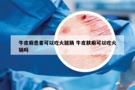 牛皮癬患者可以吃火腿腸 牛皮膚癬可以吃火鍋嗎