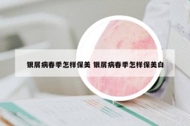 銀屑病春季怎樣保美 銀屑病春季怎樣保美白