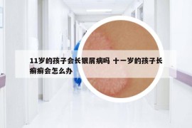 11歲的孩子會長銀屑病嗎 十一歲的孩子長癬癬會怎么辦