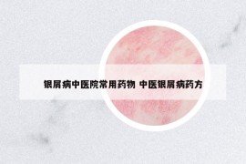 銀屑病中醫(yī)院常用藥物 中醫(yī)銀屑病藥方