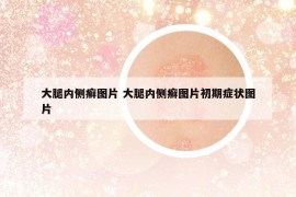 大腿內(nèi)側(cè)癬圖片 大腿內(nèi)側(cè)癬圖片初期癥狀圖片
