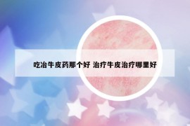 吃冶牛皮藥那個(gè)好 治療牛皮治療哪里好