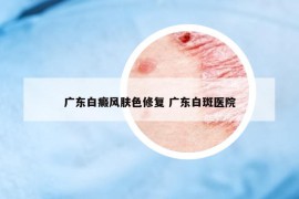 廣東白癜風膚色修復 廣東白斑醫(yī)院