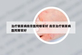 治療銀屑病南京醫(yī)院哪家好 南京治療銀屑病醫(yī)院那家好