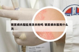 銀屑病衣服能用洗衣粉嗎 銀屑病衣服用什么洗