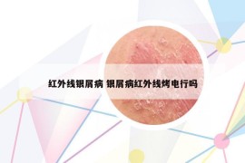 紅外線銀屑病 銀屑病紅外線烤電行嗎