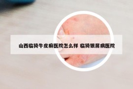 山西臨猗牛皮癬醫(yī)院怎么樣 臨猗銀屑病醫(yī)院