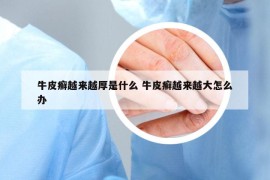 牛皮癬越來(lái)越厚是什么 牛皮癬越來(lái)越大怎么辦