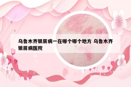 烏魯木齊銀屑病一在哪個哪個地方 烏魯木齊銀屑病醫(yī)院
