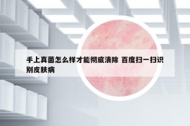 手上真菌怎么樣才能徹底清除 百度掃一掃識(shí)別皮膚病