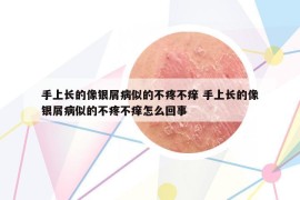 手上長的像銀屑病似的不疼不癢 手上長的像銀屑病似的不疼不癢怎么回事