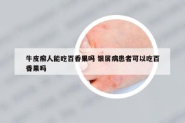 牛皮癬人能吃百香果嗎 銀屑病患者可以吃百香果嗎