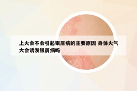 上火會不會引起銀屑病的主要原因 身體火氣大會誘發(fā)銀屑病嗎