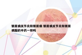 銀屑病關(guān)節(jié)炎和銀屑病 銀屑病關(guān)節(jié)炎和銀屑病服的中藥一樣嗎