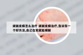 頑固皮癬怎么治療 頑固皮癬治療,告訴你一個好方法,自己在家就能緩解