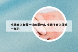 小孩身上有蘚一樣的是什么 小孩子身上像癬一樣的