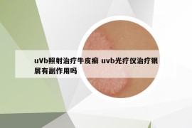 uVb照射治療牛皮癬 uvb光療儀治療銀屑有副作用嗎