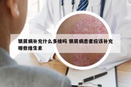 銀屑病補充什么多維嗎 銀屑病患者應(yīng)該補充哪些維生素