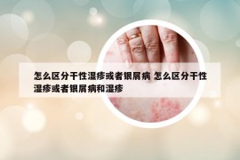 怎么區(qū)分干性濕疹或者銀屑病 怎么區(qū)分干性濕疹或者銀屑病和濕疹