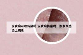 皮膚癬可以傳染嗎 皮膚癬傳染嗎一般多久感染上病毒
