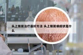 頭上銀屑治療最好方法 頭上銀屑病癥狀是什么
