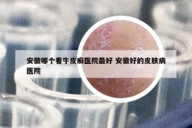 安徽哪個看牛皮癬醫(yī)院最好 安徽好的皮膚病醫(yī)院