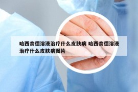 哈西奈德溶液治療什么皮膚病 哈西奈德溶液治療什么皮膚病圖片
